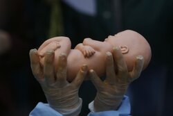 Miniatura: Zdrowie psychiczne przesłanką do aborcji?...